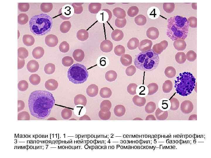  Мазок крови [11]. 1 — эритроциты; 2 — сегментоядерный нейтрофил; 3 — палочкоядерный