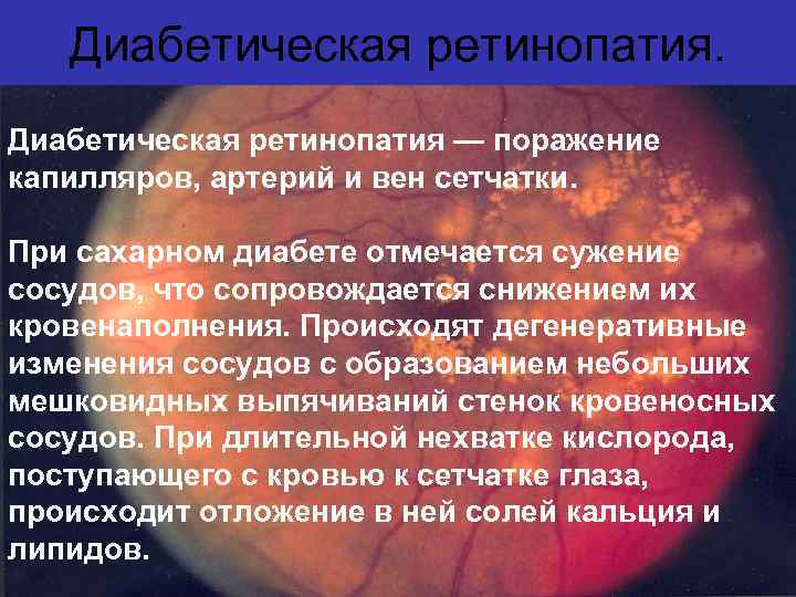 Сосуды при диабете. Изменение сетчатки при сахарном диабете. Сосуды сетчатки при сахарном диабете. Изменение сосудов при сахарном диабете. Диабетическое поражение сосудов.