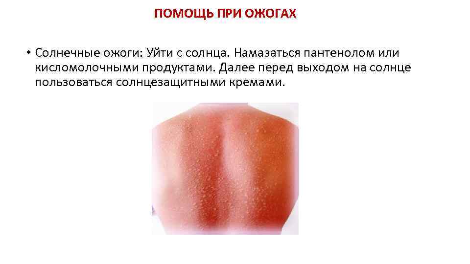 ПОМОЩЬ ПРИ ОЖОГАХ • Солнечные ожоги: Уйти с солнца. Намазаться пантенолом или кисломолочными продуктами.