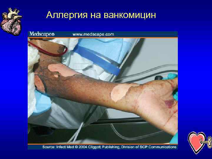 Аллергия на ванкомицин 