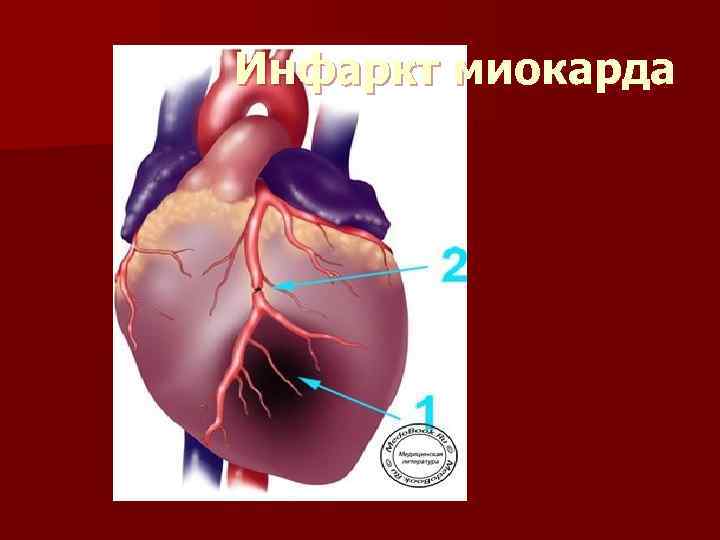 Инфаркт миокарда 