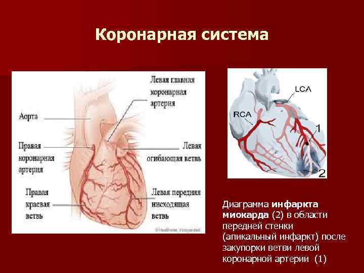 Левая стенка сердца. Передняя стенка сердца инфаркт миокарда. Коронарные артерии инфаркт. Инфаркт миокарда строение сердца.