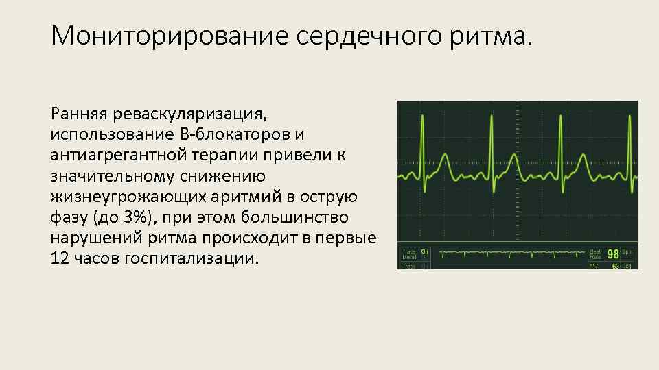 Мониторирование сердечного ритма. Ранняя реваскуляризация, использование В-блокаторов и антиагрегантной терапии привели к значительному снижению