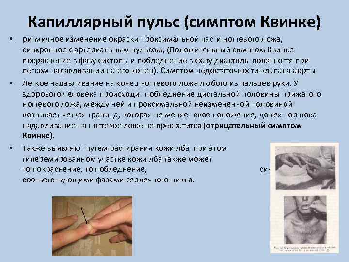 Капиллярный пульс (симптом Квинке) • • • ритмичное изменение окраски проксимальной части ногтевого ложа,