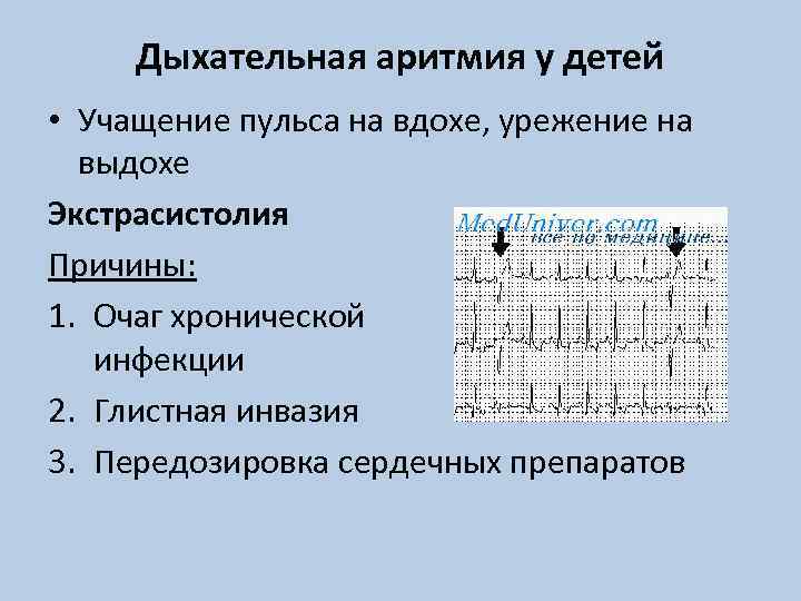 Дыхательная аритмия у детей • Учащение пульса на вдохе, урежение на выдохе Экстрасистолия Причины: