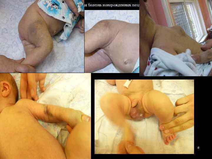 Геморрагическая болезнь новорожденных поздняя форма 8 