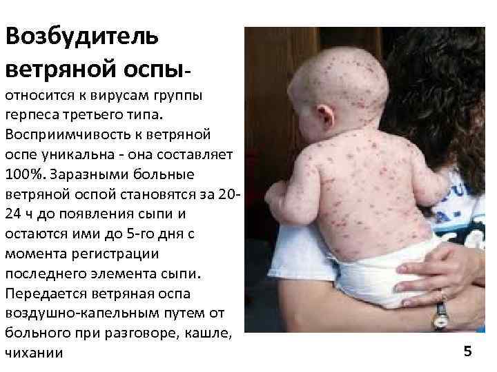 Возбудитель ветряной оспы- относится к вирусам группы герпеса третьего типа. Восприимчивость к ветряной оспе