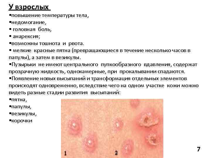 У взрослых §повышение температуры тела, §недомогание, § головная боль, § анарексия; §возможны тошнота и