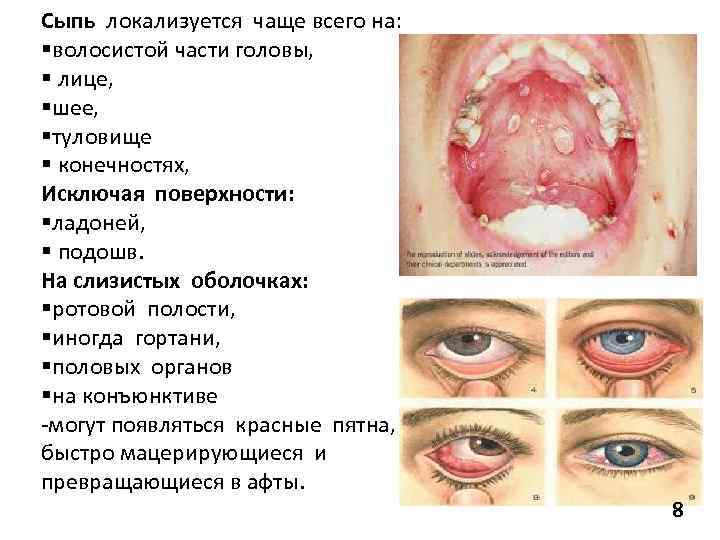 Сыпь локализуется чаще всего на: §волосистой части головы, § лице, §шее, §туловище § конечностях,
