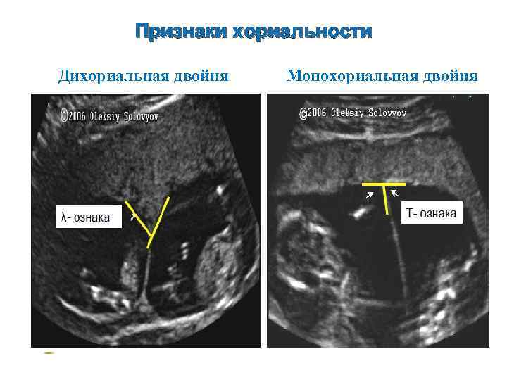 Признаки хориальности Дихориальная двойня Монохориальная двойня 