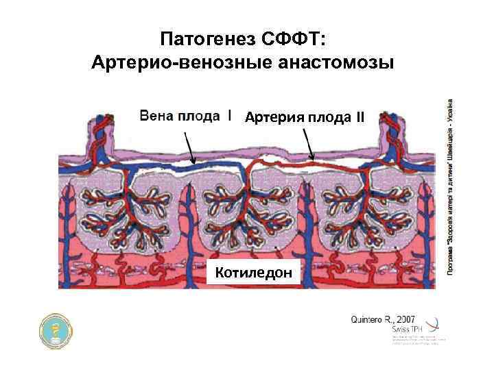 Патогенез СФФТ: Артерио-венозные анастомозы Артерия плода ІІ Котиледон 