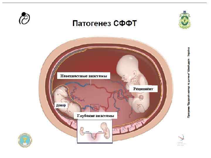 Повехностные анастомы Реципиент Глубокие анастомы 