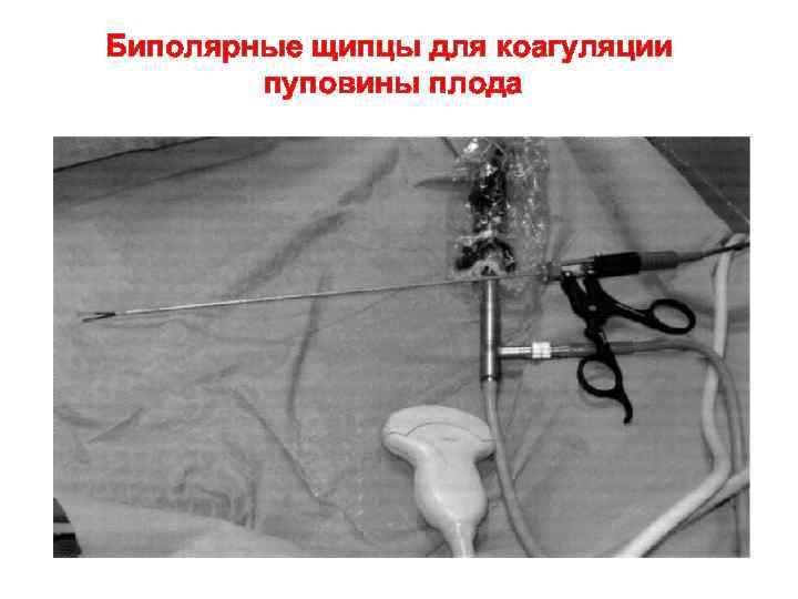 Биполярные щипцы для коагуляции пуповины плода 