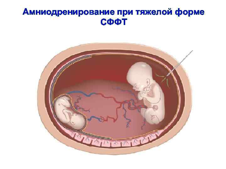 Амниодренирование при тяжелой форме СФФТ 