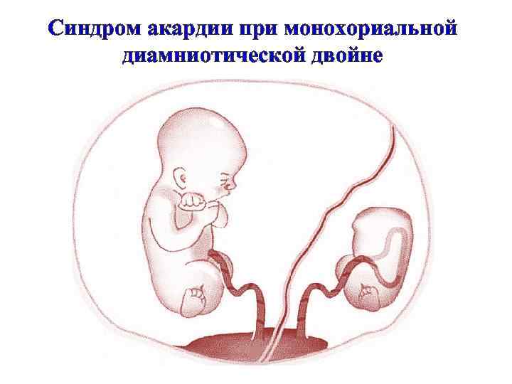Синдром акардии при монохориальной диамниотической двойне 