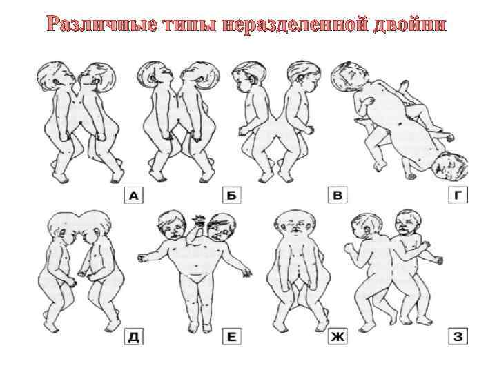 Различные типы неразделенной двойни 