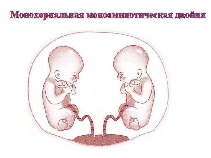 Монохориальная моноамниотическая двойня 