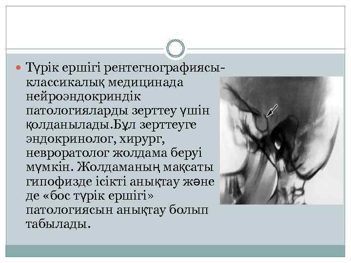  Түрік ершігі рентегнографиясы- классикалық медицинада нейроэндокриндік патологияларды зерттеу үшін қолданылады. Бұл зерттеуге эндокринолог,