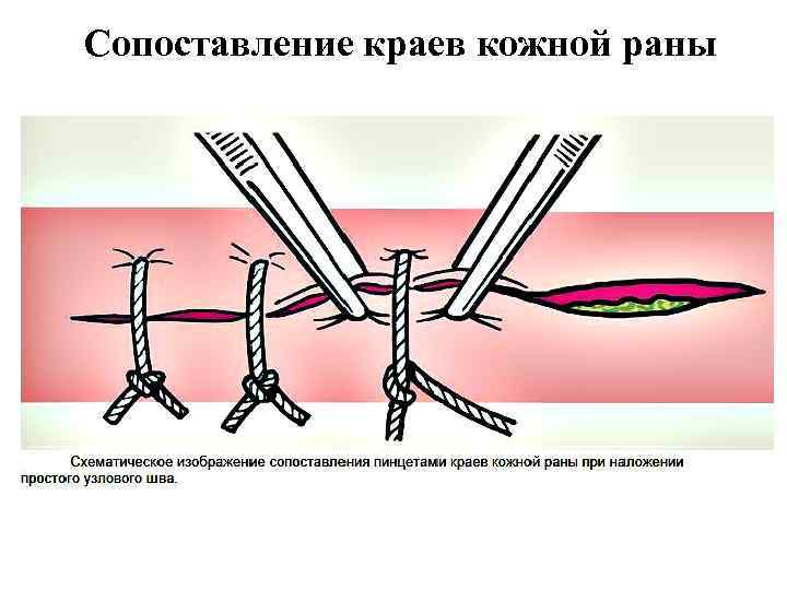 Краев ран. Сопоставление краев раны.