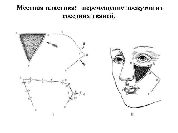 Местная пластика: перемещение лоскутов из соседних тканей. 