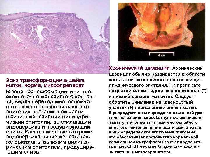Хронический цервицит. Хронический Зона трансформации в шейке матки, норма, микропрепарат В зоне трансформации, или