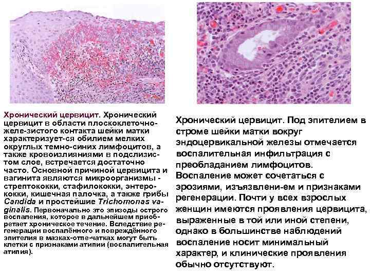 Хронический цервицит в области плоскоклеточно желе зистого контакта шейки матки характеризует ся обилием мелких