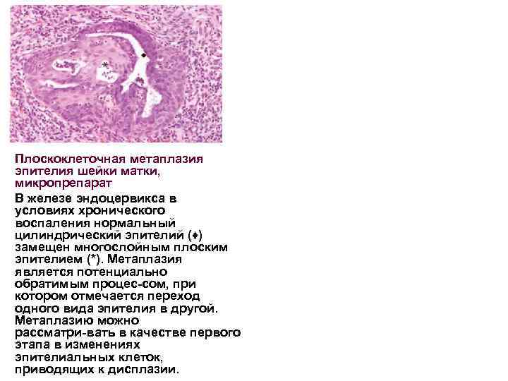 Плоскоклеточная метаплазия эпителия шейки матки, микропрепарат В железе эндоцервикса в условиях хронического воспаления нормальный