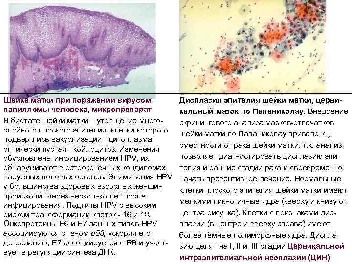 Шейка матки при поражении вирусом папилломы человека, микропрепарат В биотате шейки матки – утолщение
