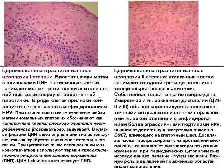 Цервикальная интраэпителиальная неоплазия I степени. Биоптат шейки матки с признаками ЦИН I: атипичные клетки