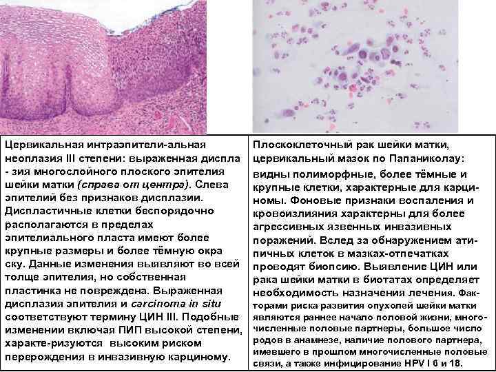 Цервикальная интраэпители альная неоплазия III степени: выраженная диcпла зия многослойного плоского эпителия шейки матки