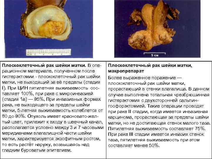 Плоскоклеточный рак шейки матки. В опе рационном материале, полученном после гистерэктомии плоскоклеточный рак шейки