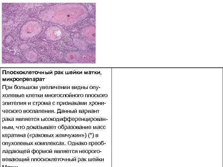 Плоскоклеточный рак шейки матки, микропрепарат При большом увеличении видны опу холевые клетки многослойного плоского
