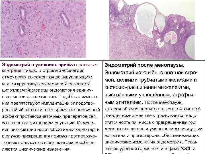 Эндометриальный полип матки гистология. Клетки эндометрия матки. Децидуализацию ткани эндометрия.