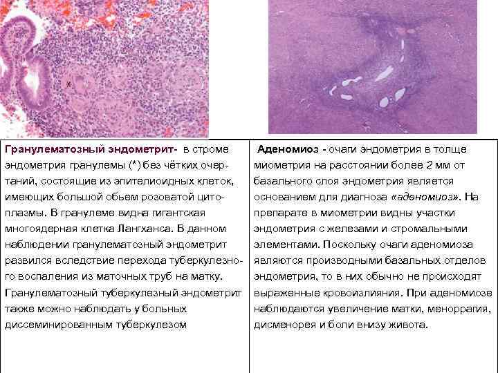 Гранулематозный эндометрит в строме эндометрия гранулемы (*) без чётких очер таний, состоящие из эпителиоидных