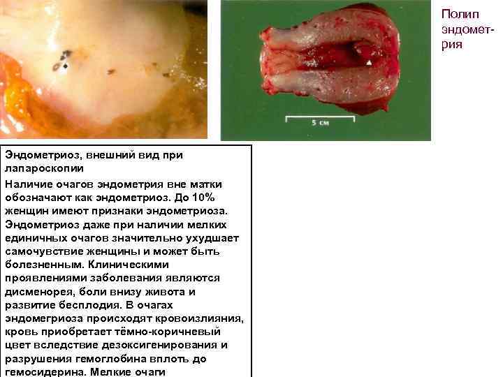 Полип эндомет рия Эндометриоз, внешний вид при лапароскопии Наличие очагов эндометрия вне матки обозначают
