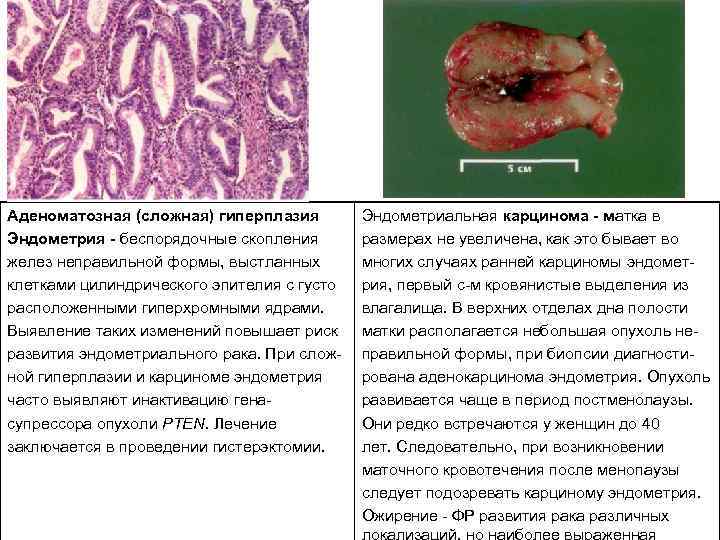 Аденоматозная (сложная) гиперплазия Эндометрия беспорядочные скопления желез неправильной формы, выстланных клетками цилиндрического эпителия с