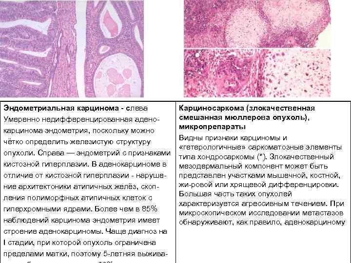 Эндометриальная карцинома слева Умеренно недифференцированная адено карцинома эндометрия, поскольку можно чётко определить железистую структуру