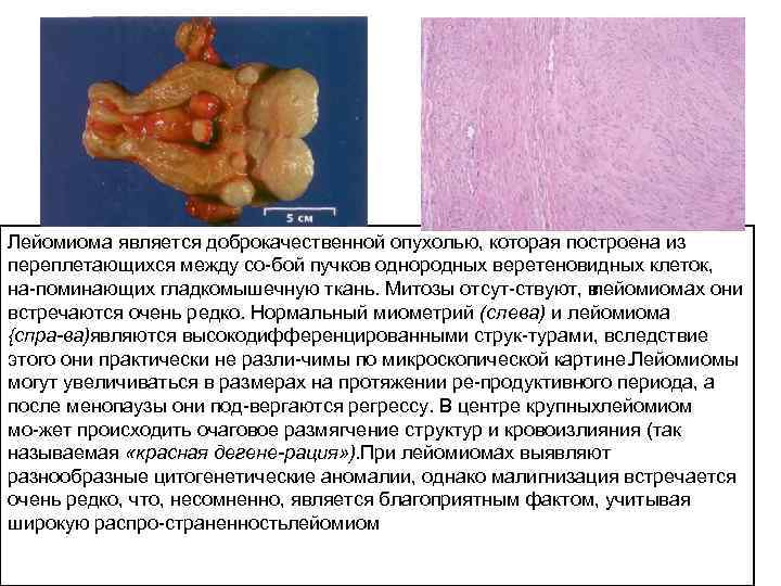 Лейомиома является доброкачественной опухолью, которая построена из переплетающихся между со бой пучков однородных веретеновидных