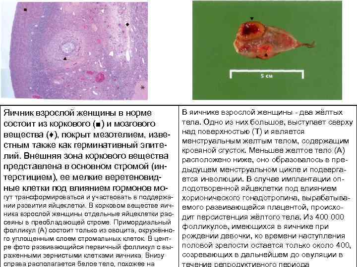 В яичнике взрослой женщины два жёлтых тела. Одно из них большое, выступает сверху над
