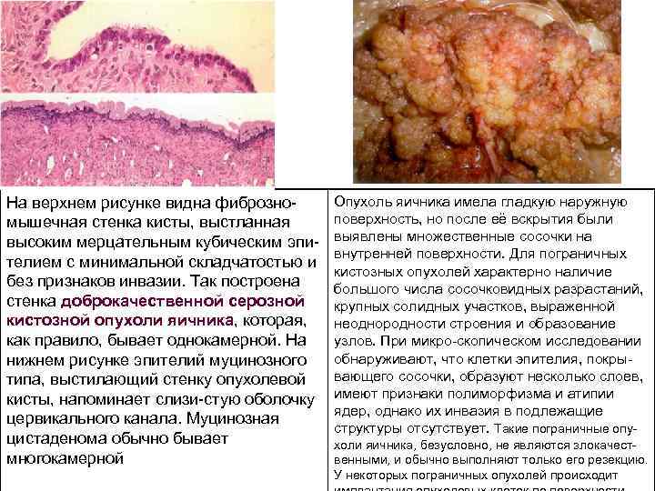 На верхнем рисунке видна фиброзно мышечная стенка кисты, выстланная высоким мерцательным кубическим эпи телием