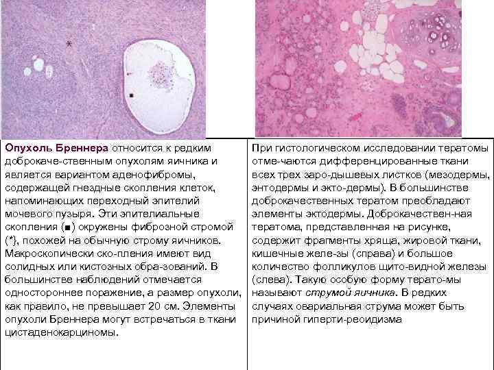 Опухоль Бреннера относится к редким доброкаче ственным опухолям яичника и является вариантом аденофибромы, содержащей