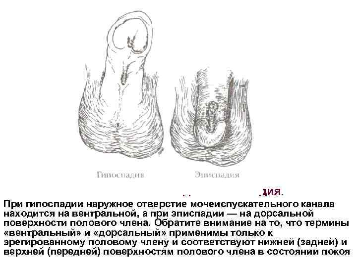 Рис. 18. 1. Гипоспадия и эписпадия. При гипоспадии наружное отверстие мочеиспускательного канала находится на