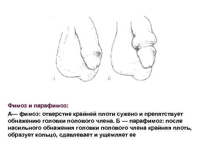 Фимоз и парафимоз: А— фимоз: отверстие крайней плоти сужено и препятствует обнажению головки полового