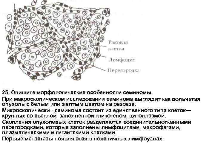 25. Опишите морфологические особенности семиномы. При макроскопическом исследовании семинома выглядит как дольчатая опухоль с