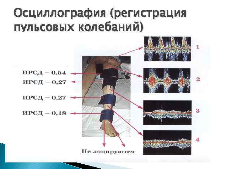 Осциллография (регистрация пульсовых колебаний) 