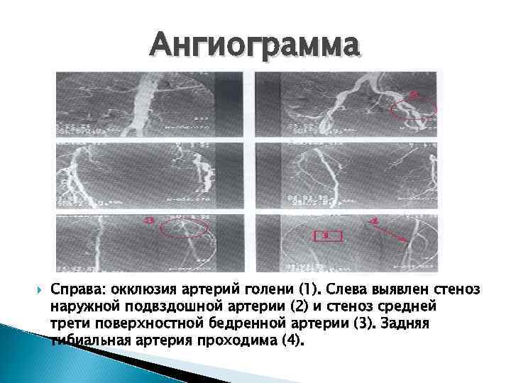 Пролежни хирургия презентация