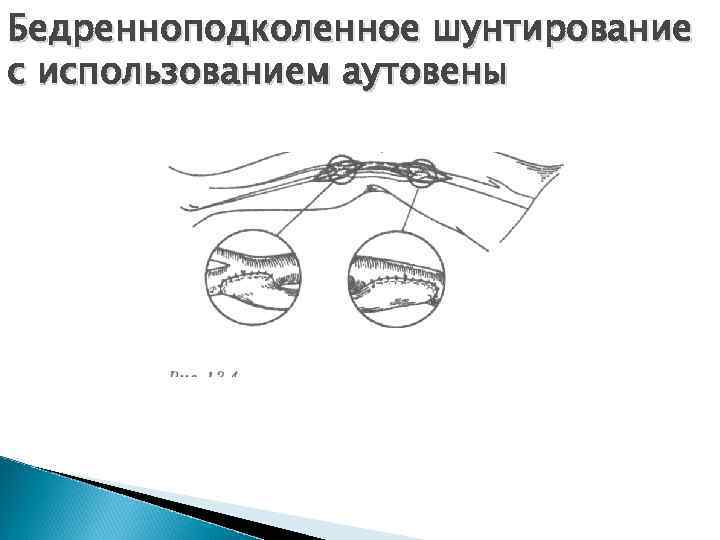 Бедренноподколенное шунтирование с использованием аутовены 