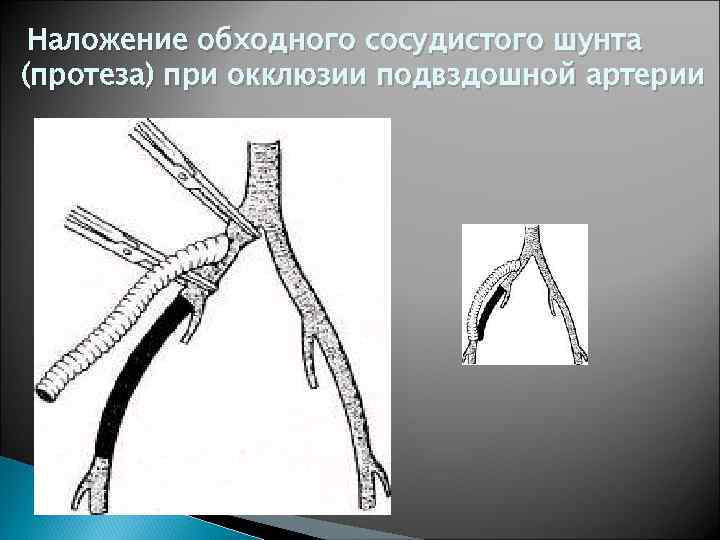 Наложение обходного сосудистого шунта (протеза) при окклюзии подвздошной артерии 