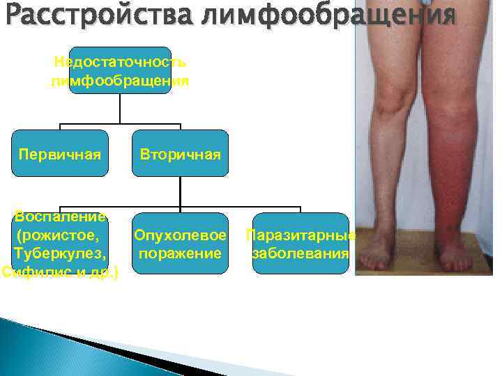 Расстройства лимфообращения Недостаточность лимфообращения Первичная Вторичная Воспаление (рожистое, Опухолевое поражение Туберкулез, Сифилис и др.