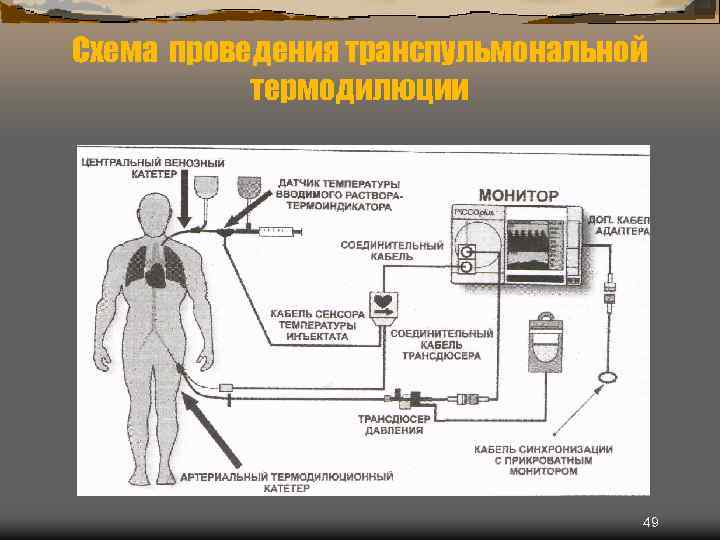 Схема проведения транспульмональной термодилюции 49 